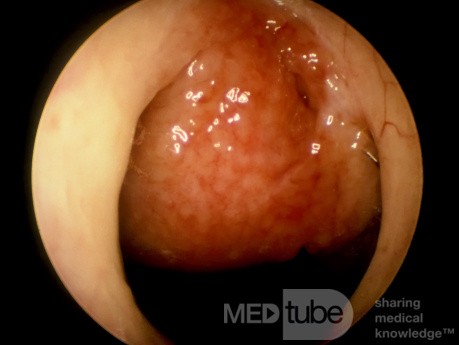 Thornwaldt's Bursa [Cyst]