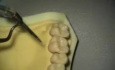 Ultrasonic Endoscopic  Debridement Simulation (UR)
