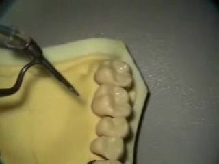 Ultrasonic Endoscopic  Debridement Simulation (UR)