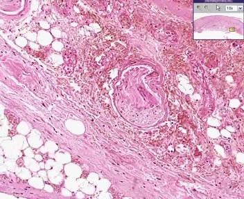 Skin - Dry Gangrene