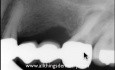 Endodontics Case - Retreat The Retreat?