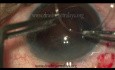 Traumatic Cataract with Subluxated Lens