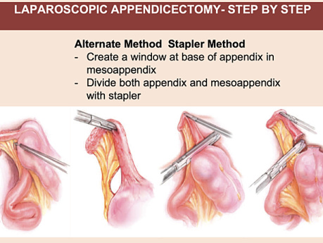 Acute Appendicitis - Appendicectomy - Open & Laparoscopic