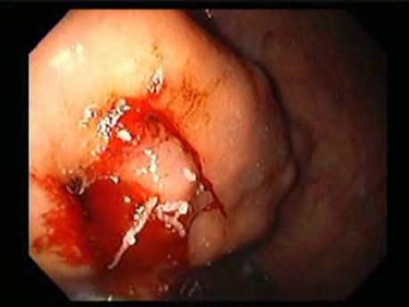 Gastric Varices - Endoscopic Ablation With Cyanoacrylate Glue (9 of 18)