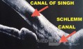 Schlemm Canal and Singh Canal Connection

