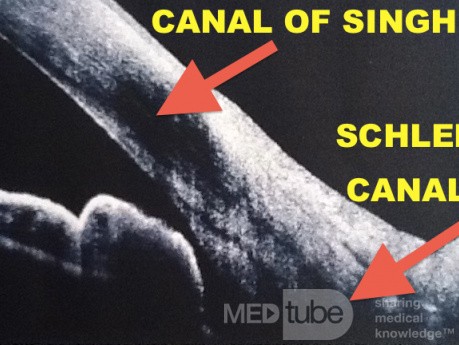Schlemm Canal and Singh Canal Connection
