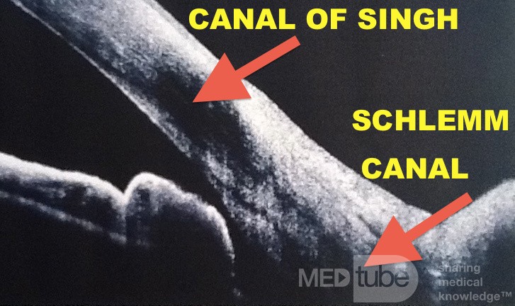 Schlemm Canal and Singh Canal Connection
