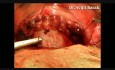 Cesarean Section Under Local Anaesthesia by Dr.Avijit Basak