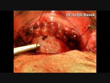 Cesarean Section Under Local Anaesthesia by Dr.Avijit Basak