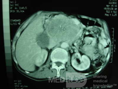 Gastric Ulcer with Gastrocolic fistula due to a Zollinger-
 Ellison Syndrome (24 of 33)