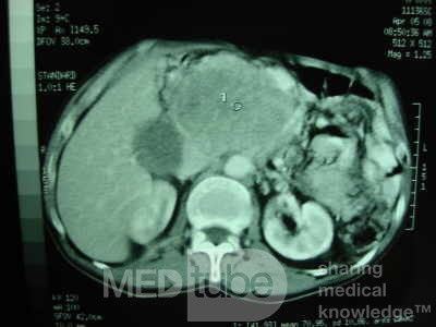 Gastric Ulcer with Gastrocolic fistula due to a Zollinger-
 Ellison Syndrome (24 of 33)