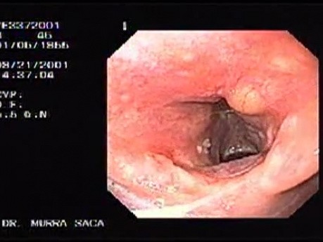 Small papilomas of the larynx