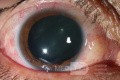 Ocular Trauma (before)