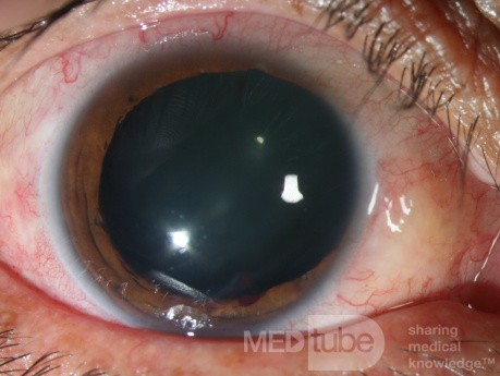 Ocular Trauma (before)