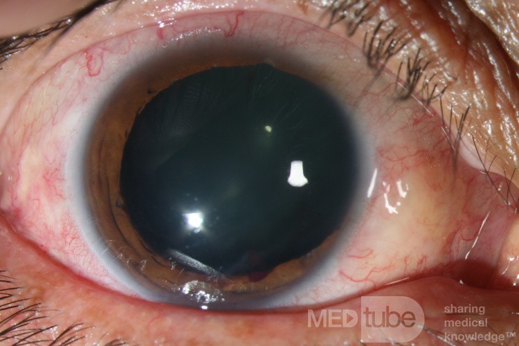 Ocular Trauma (before)
