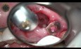 Teeth Extraction with Simultaniously Dental Implants Using Laser Beam
