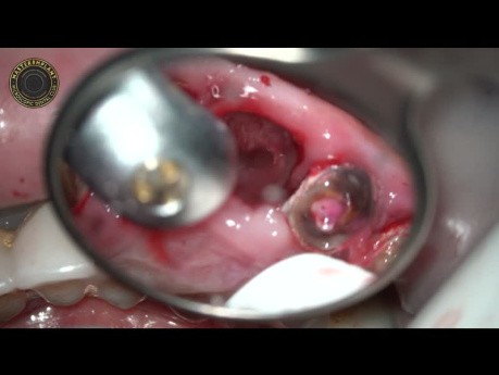 Teeth Extraction with Simultaniously Dental Implants Using Laser Beam