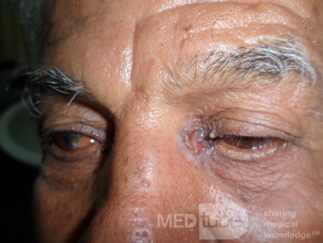 Basal Cell Carcinoma 