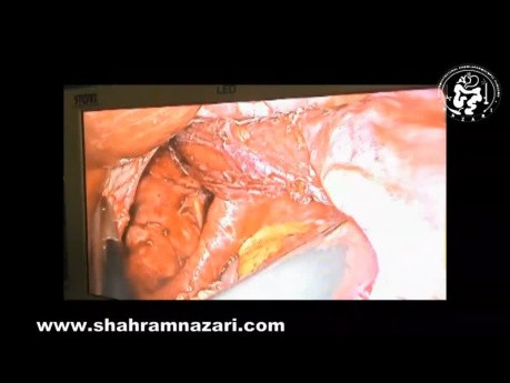 Laparoscopic Management of Totally Intra-Thoracic Stomach with Chronic Volvulus