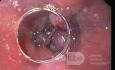 Esophageal Varices After Endoscopic Banding