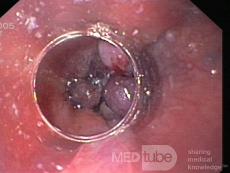 Esophageal Varices After Endoscopic Banding