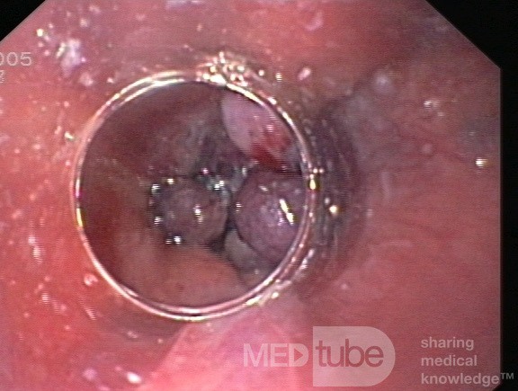 Esophageal Varices After Endoscopic Banding