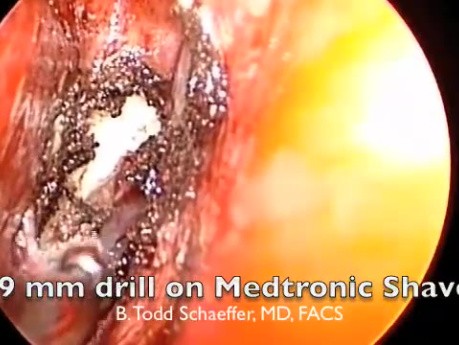 Correction of Choanal Atresia