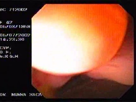 Crohn´s Disease (16 of 28)