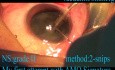 Quick Phacoemulsification 1 (AMO Signature)