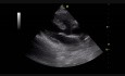 Sub Aortic VSD (1)