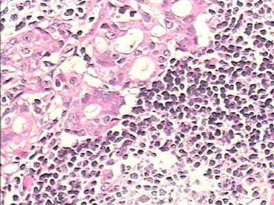 Adenocarcinoma of the cardias and gastric fundus with signet-ring cells (24 of 25)