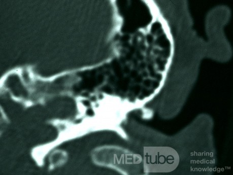 Pedunculated Osteoma of the External Canal [axial CT Scan]