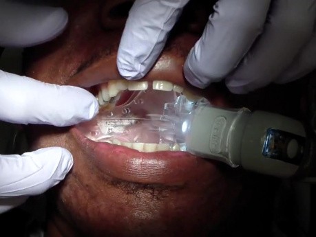 Isolite Intraoral Overview