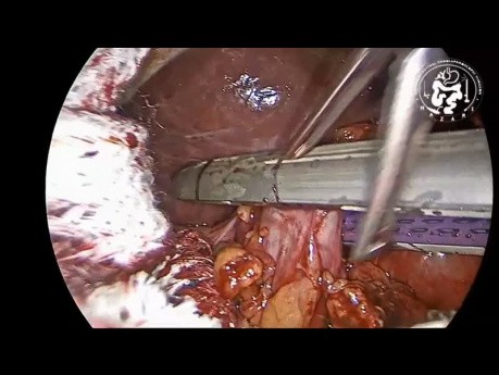Cholecystocolic Fistula