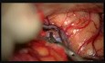 Tricky MCA Aneurysm