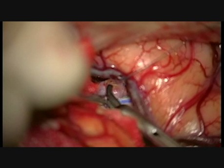 Tricky MCA Aneurysm