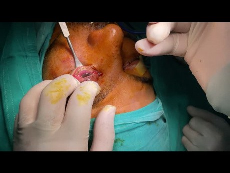 Transconjuctival Approach