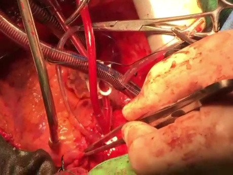 Rapid Sequence Heart Transplant Points and Tricks 