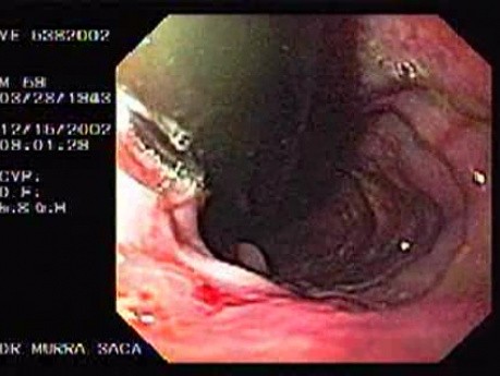 Schatzki Ring and Varices