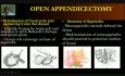 Open Appendicectomy