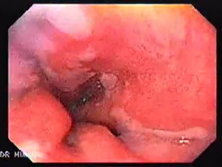 Barrett Esophagus (1 of 6)