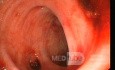 Bleeding From Sigmoid Diverticula