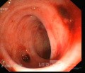 Bleeding From Sigmoid Diverticula