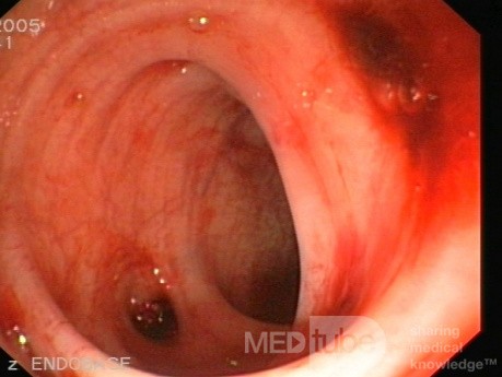 Bleeding From Sigmoid Diverticula