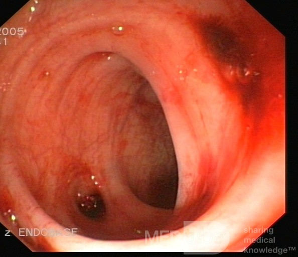 Bleeding From Sigmoid Diverticula