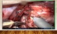 Robotic Bronchoplasty