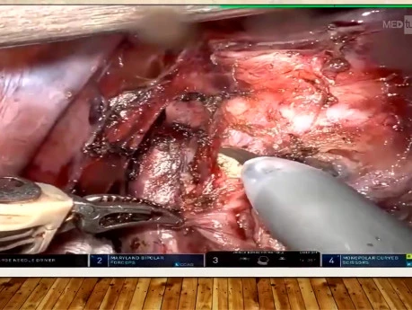 Robotic Bronchoplasty