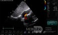 Patent Foramen Ovale (PFO)