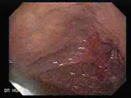 Reflux Esophagitis and Adenocarcinoma of the Antrum (1 of 3)