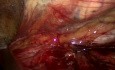 Incarcerated Inguinal Hernia (TAPP)